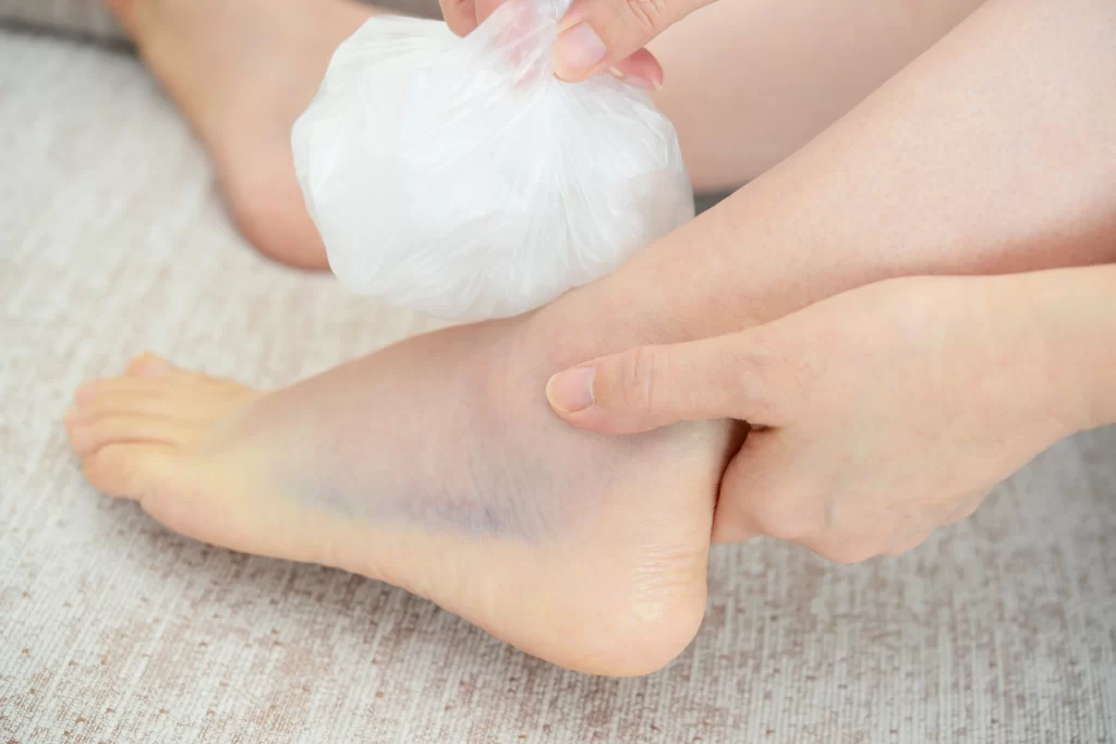 足首の捻挫は早期治療が鍵！！！