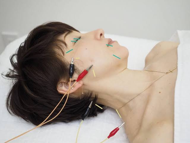 美容鍼って実際どうなの？？